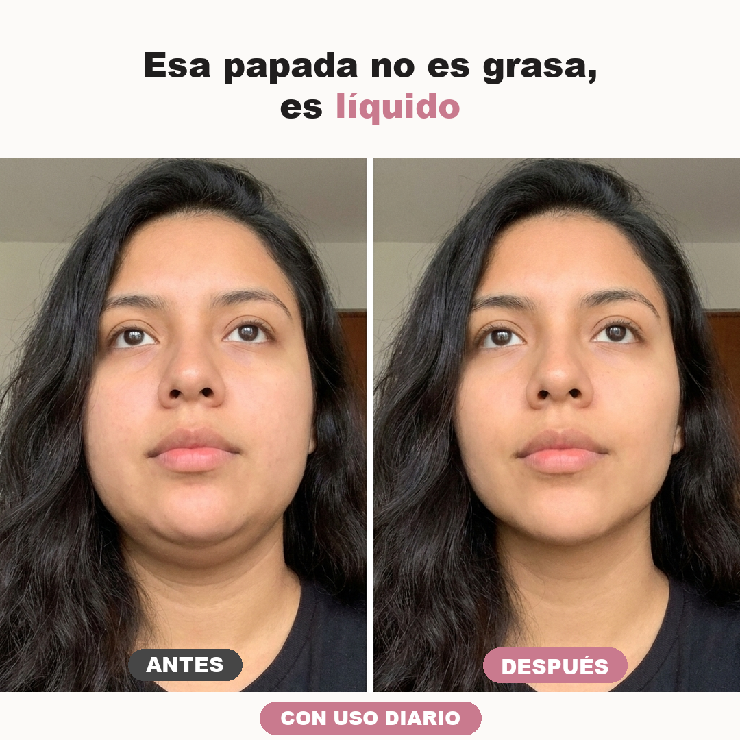 Antes despues papada