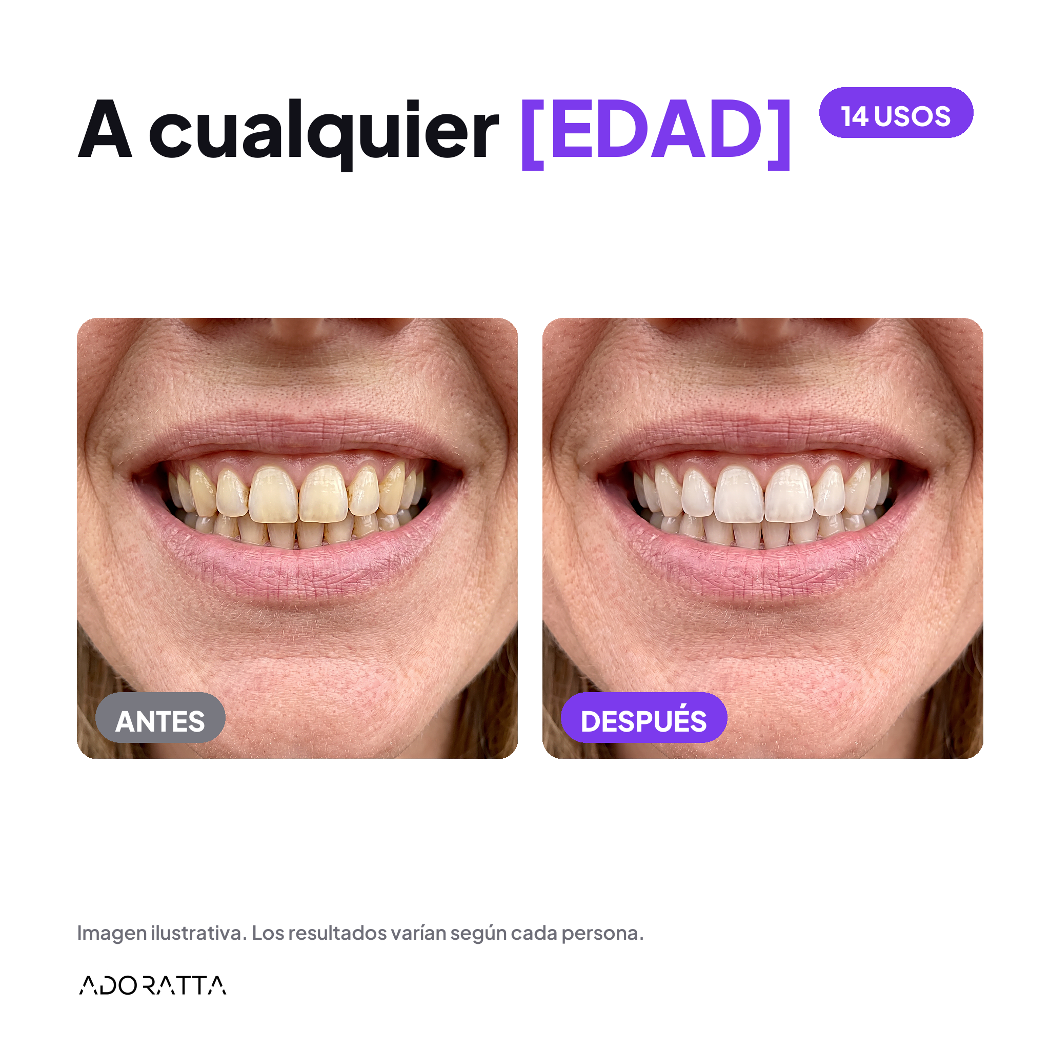 SmileKit antes despues 2