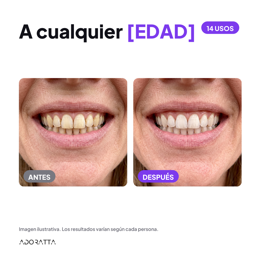 SmileKit antes despues 2