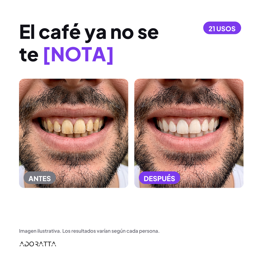 SmileKit antes despues 3